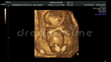4D婴儿超声扫描.